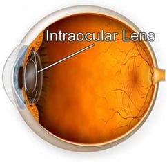Example of an intraocular lens