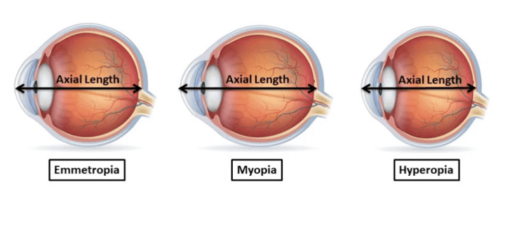 Myopia (1)