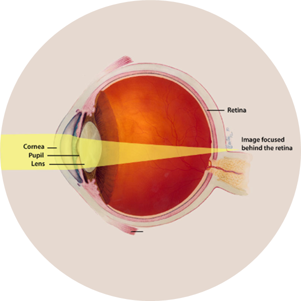 Presbyopia Round