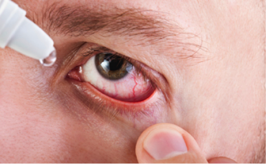 Dry Eye & LASIK