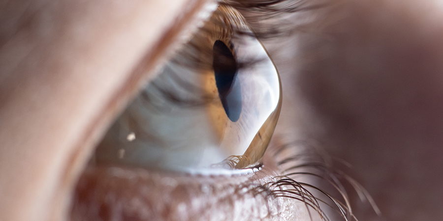 Corneal Crosslinking Slows Keratoconus and May Improve Vision