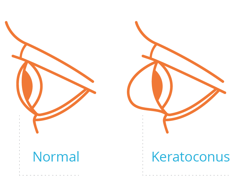 Keratoconus