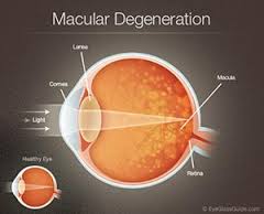 Macular_Degeneration