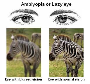 amblyopia