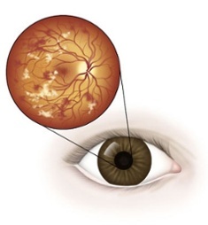 diabetic-eye