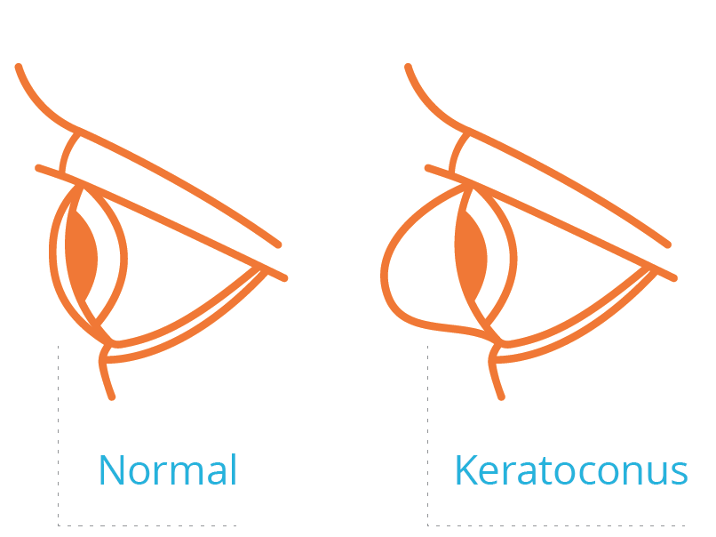 What is Keratoconus?