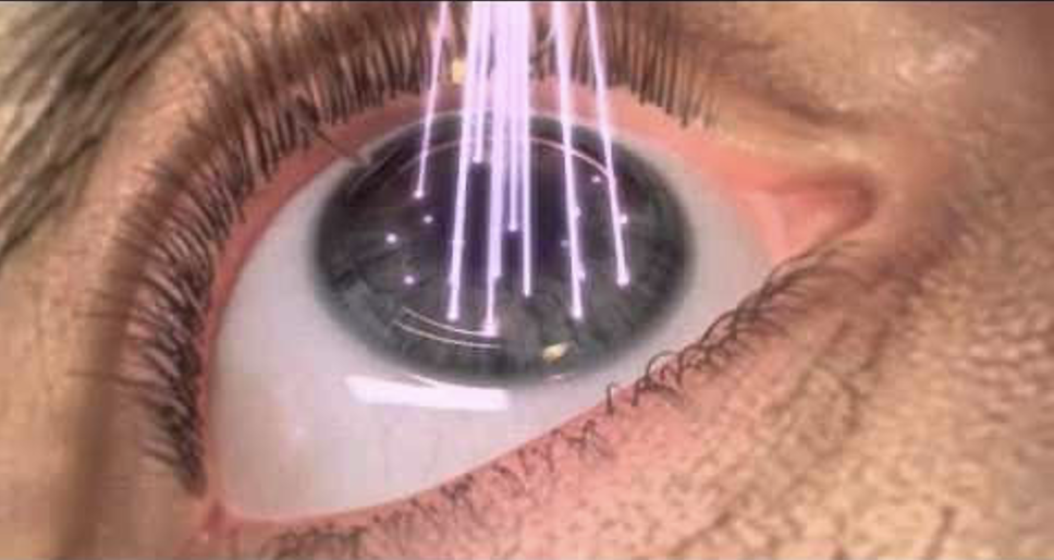 7 Things About LASIK Surgery