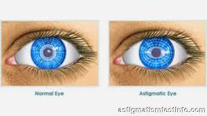 LASIK and Astigmatism, Are You A Candidate?