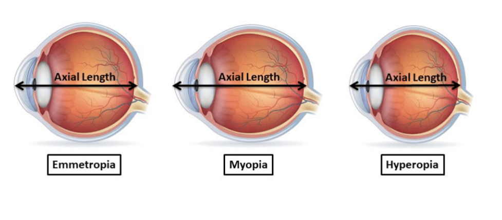 Myopia - The Great Debate!