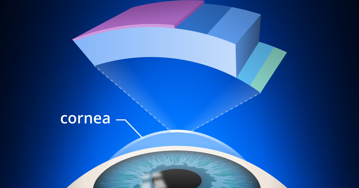 Can I have LASIK if I have Keratoconus?