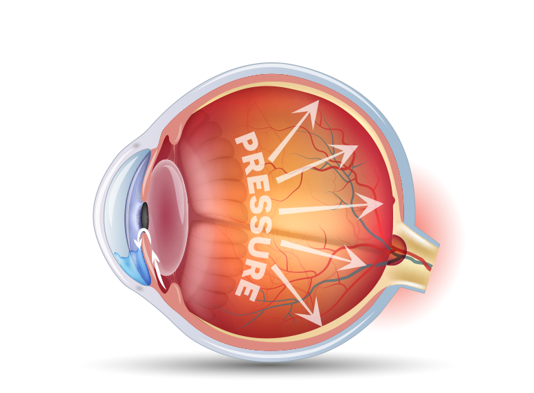 A new FDA-approved Glaucoma treatment