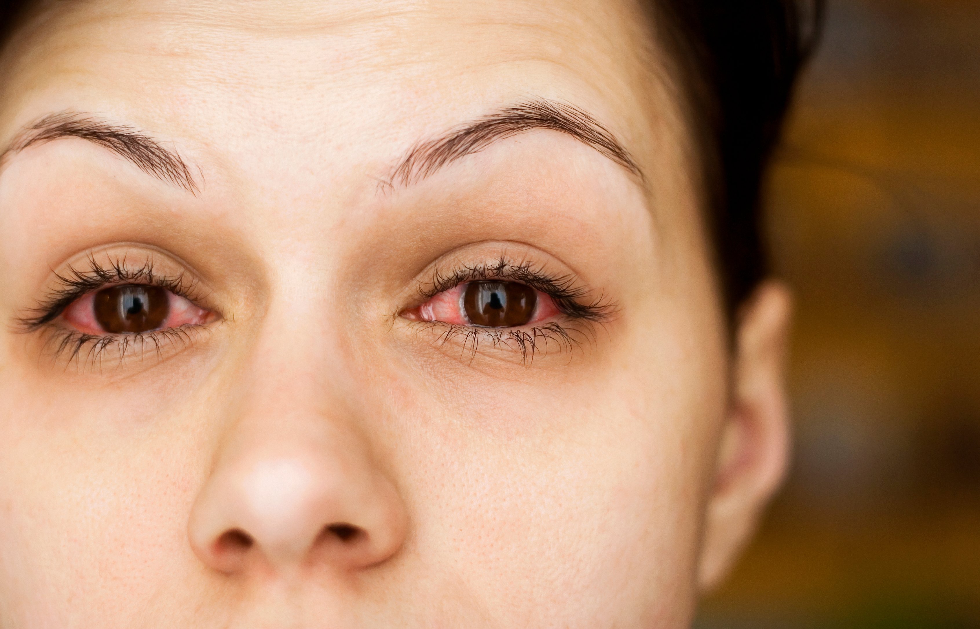 Basic causes of red, irritated eyes